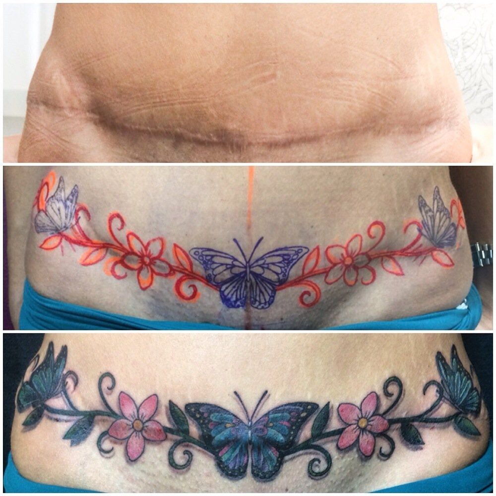 Aggregate 66 Tummy Tuck Scar Tattoo Cover Up Best In Eteachers