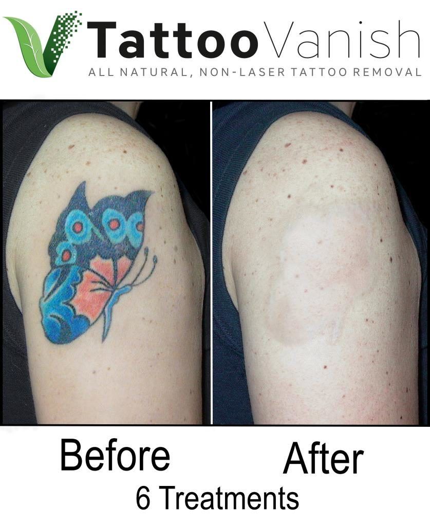 Best Wrecking Balm Tattoo Removal Before And After