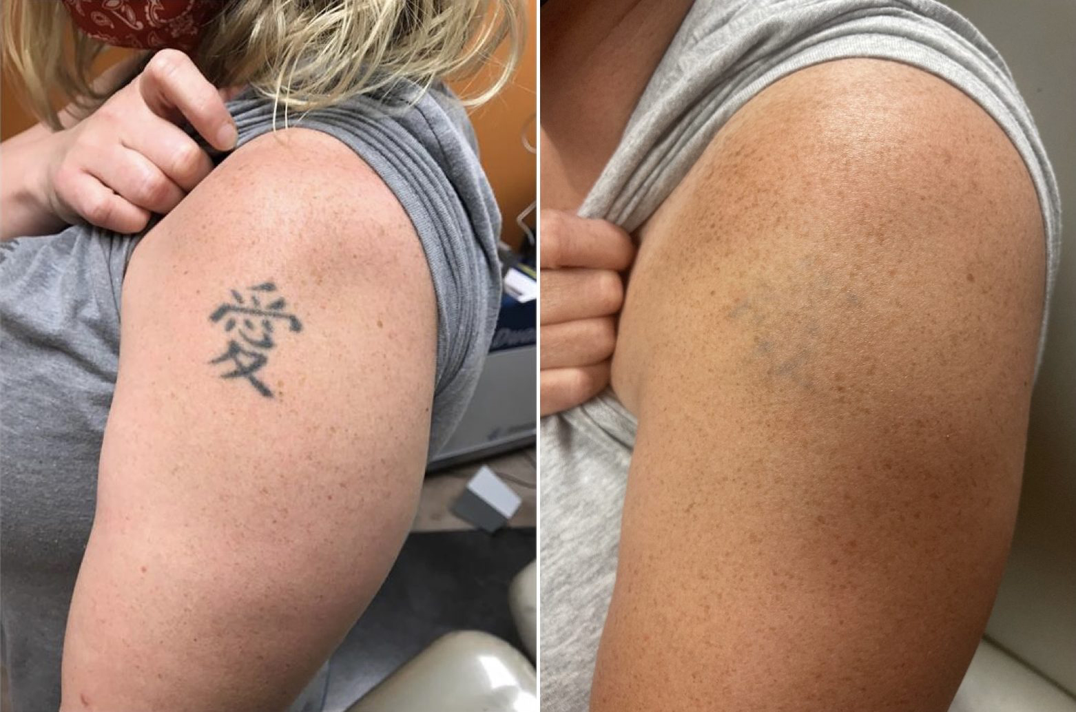 Tattoo Removal Brainerd Mn Marilu Koehler