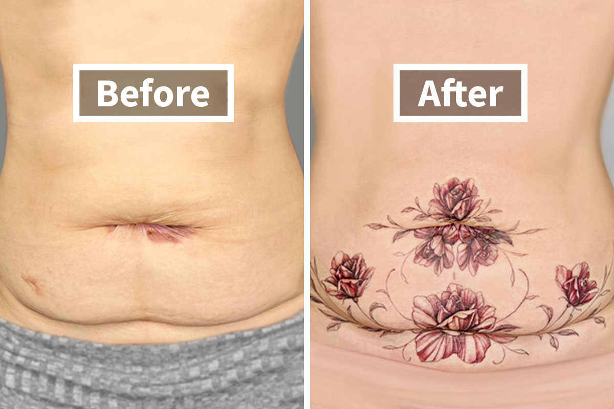 Update 54 Tummy Tuck Tattoo Cover Up Latest In Cdgdbentre